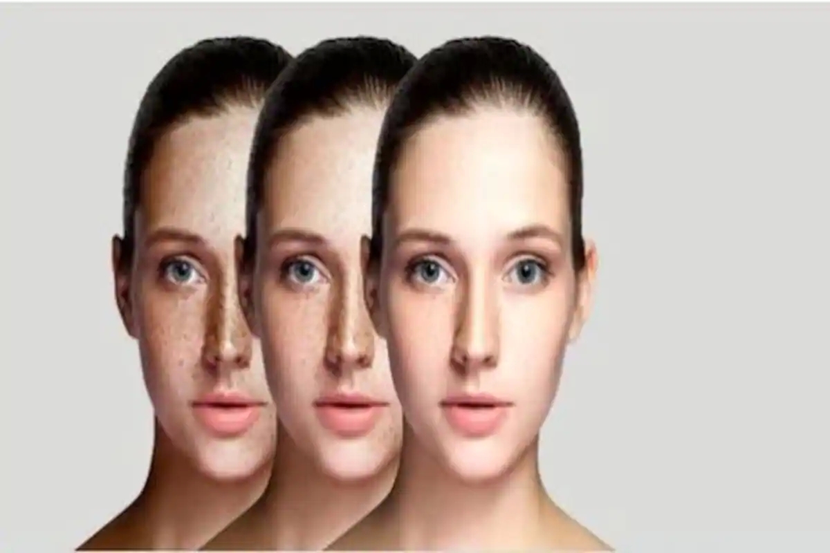 Guide on avoiding hyperpigmentation