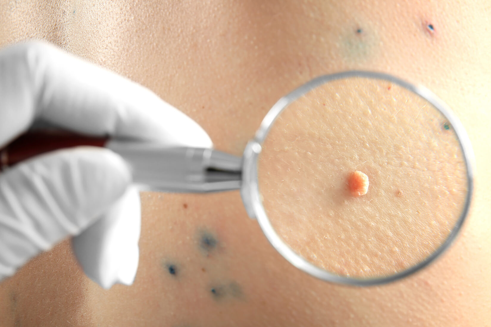 How Come Folks Get Skin Tag Removal Singapore?